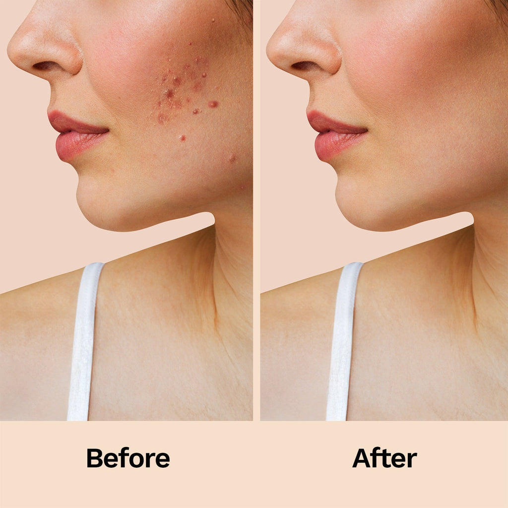 Furr Pimple Patches 12N
