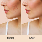 Furr Pimple Patches 12N