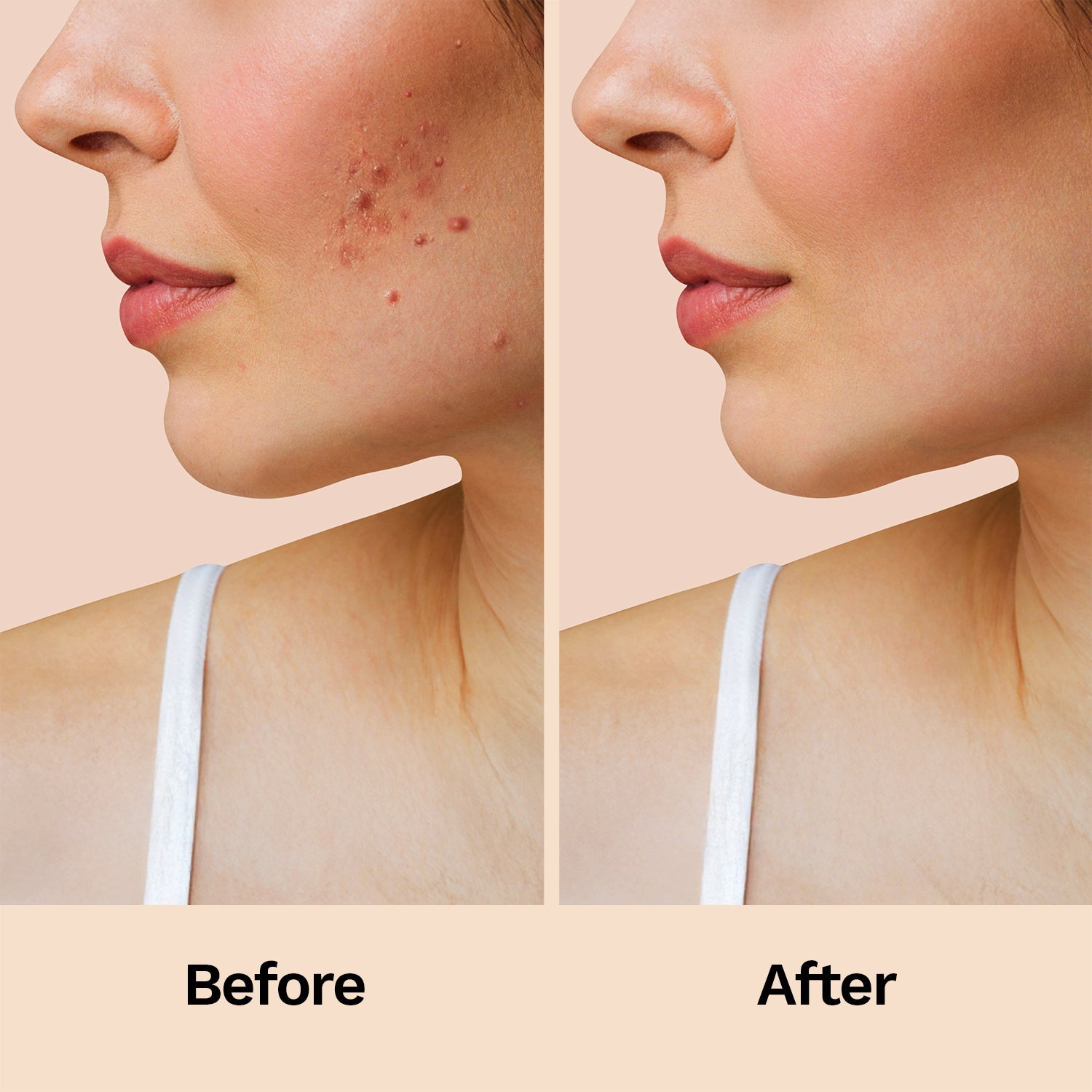 Furr Pimple Patches 12N