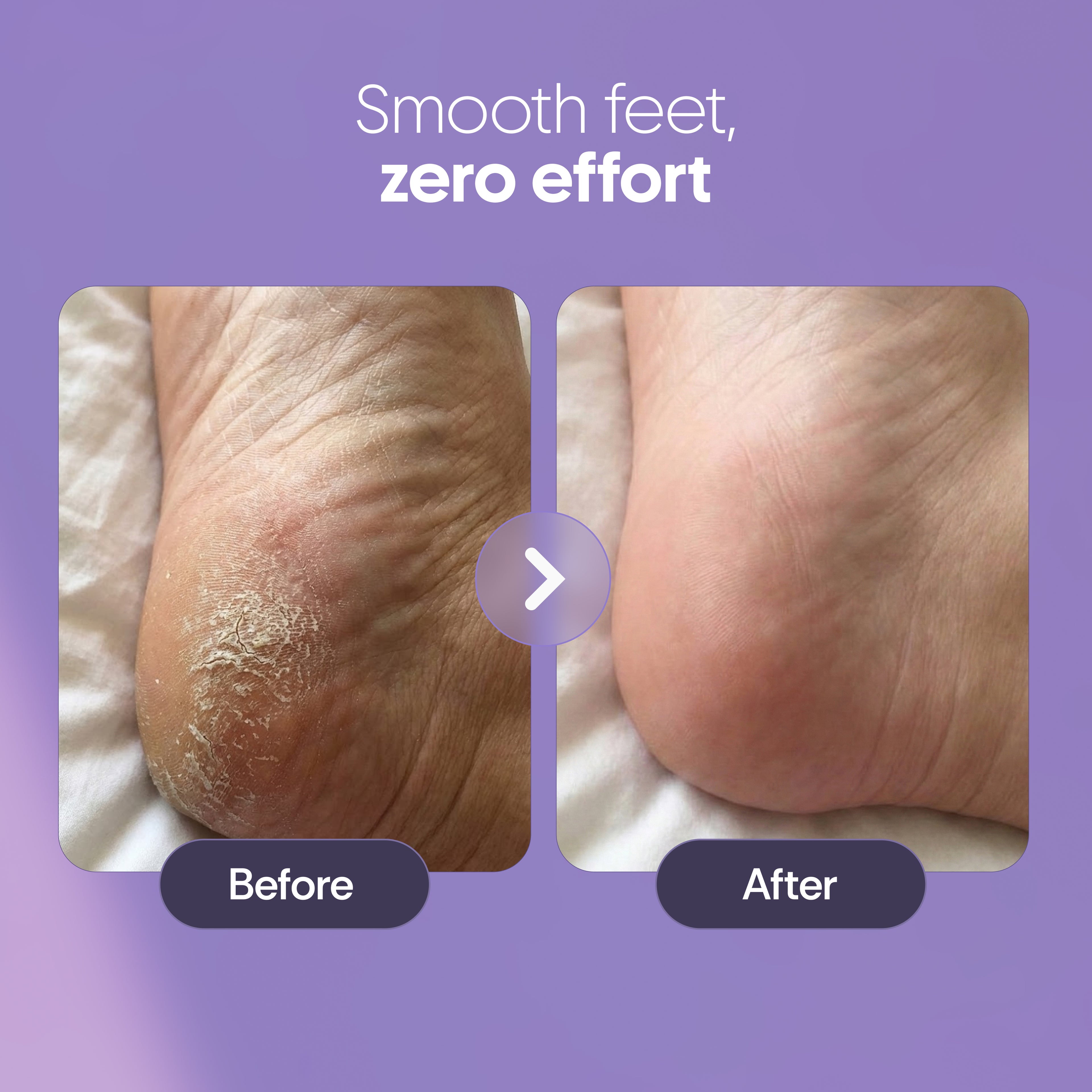 Foot Callus Remover