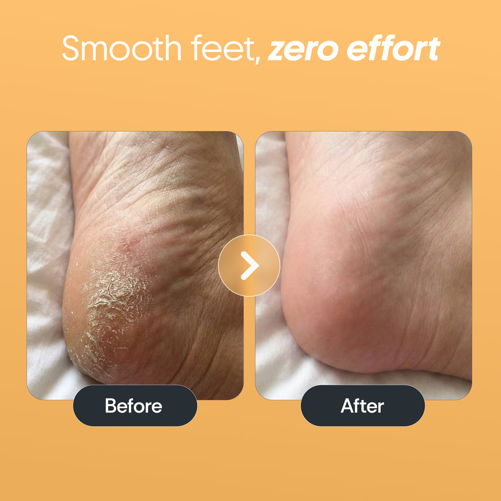Foot Callus Remover