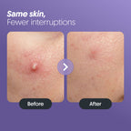Pimple Patches (30 Patches)