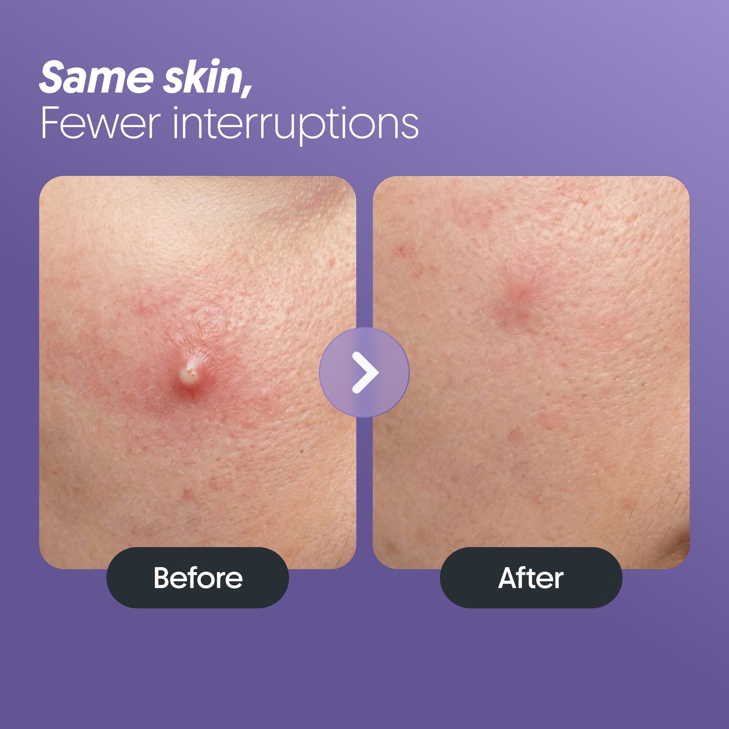 Pimple Patches (30 Patches)