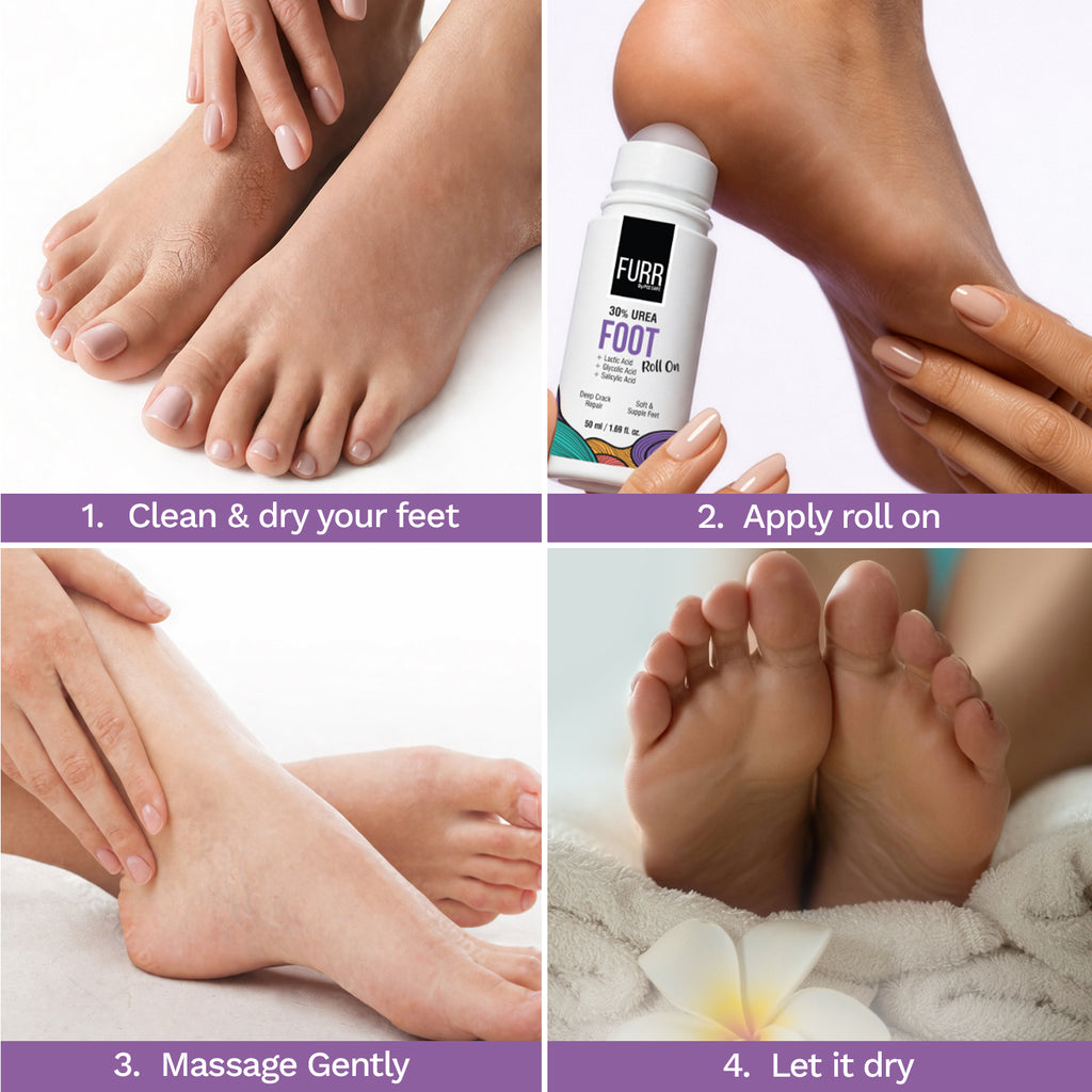 30% Urea Foot Roll-On